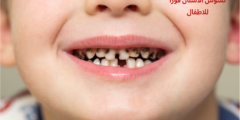 دواء لتسكين ألم تسوس الأسنان فورًا للاطفال.. وما هو سبب تسوس الأسنان لدى الأطفال؟