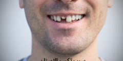 سبب تكسر الاسنان | وما هي الاضرار الناتجة عن تكسر الاسنان؟