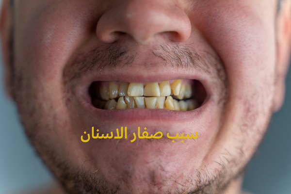 سبب صفار الاسنان