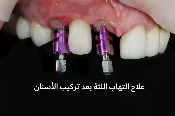 علاج التهاب اللثة بعد تركيب الأسنان