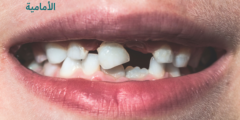 علاج اهتزاز الأسنان الأمامية | وما هي اسباب اهتزاز الاسنان الامامية؟