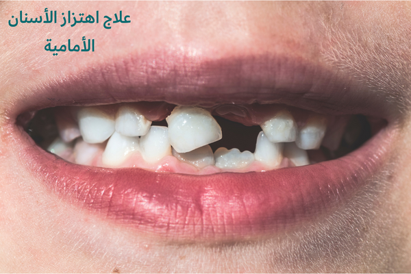علاج اهتزاز الأسنان الأمامية