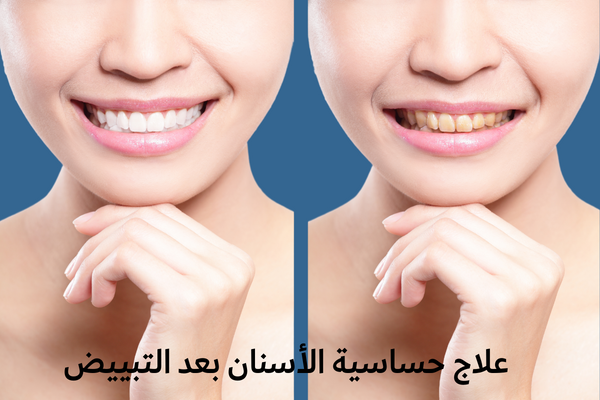 علاج حساسية الأسنان بعد التبييض