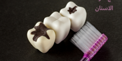 علاج سوسة الاسنان | تعرف على كيفية القضاء على سوسة الاسنان نهائياً