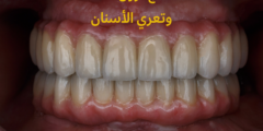 علاج نزول اللثة وتعري الأسنان | تعرف على أهم أسباب نزول اللثة وتعري الأسنان