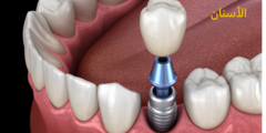 مخاطر زراعة الأسنان | وما هي مضاعفات زراعة الاسنان؟