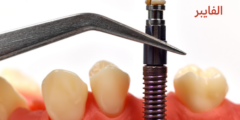 وتد الأسنان الفايبر | تعرف على طريقة تركيب وتد الاسنان الفايبر