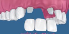 جسر الاسنان الثابت.. وما هي أفضل أنواع جسور الأسنان
