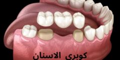 كوبرى الاسنان.. ما هي مميزات تركيب كوبرى الاسنان؟